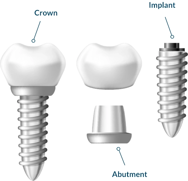 Diagram of the three parts of a dental implant