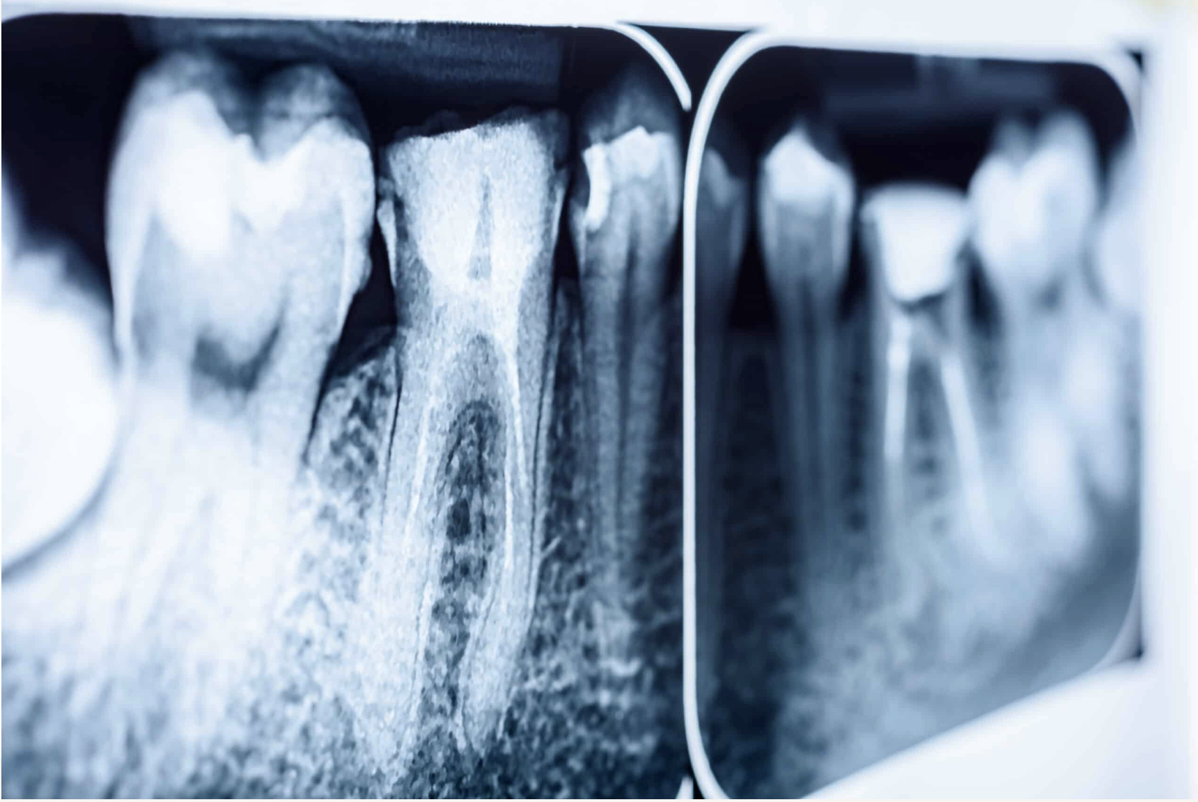 Root canal X-ray detail